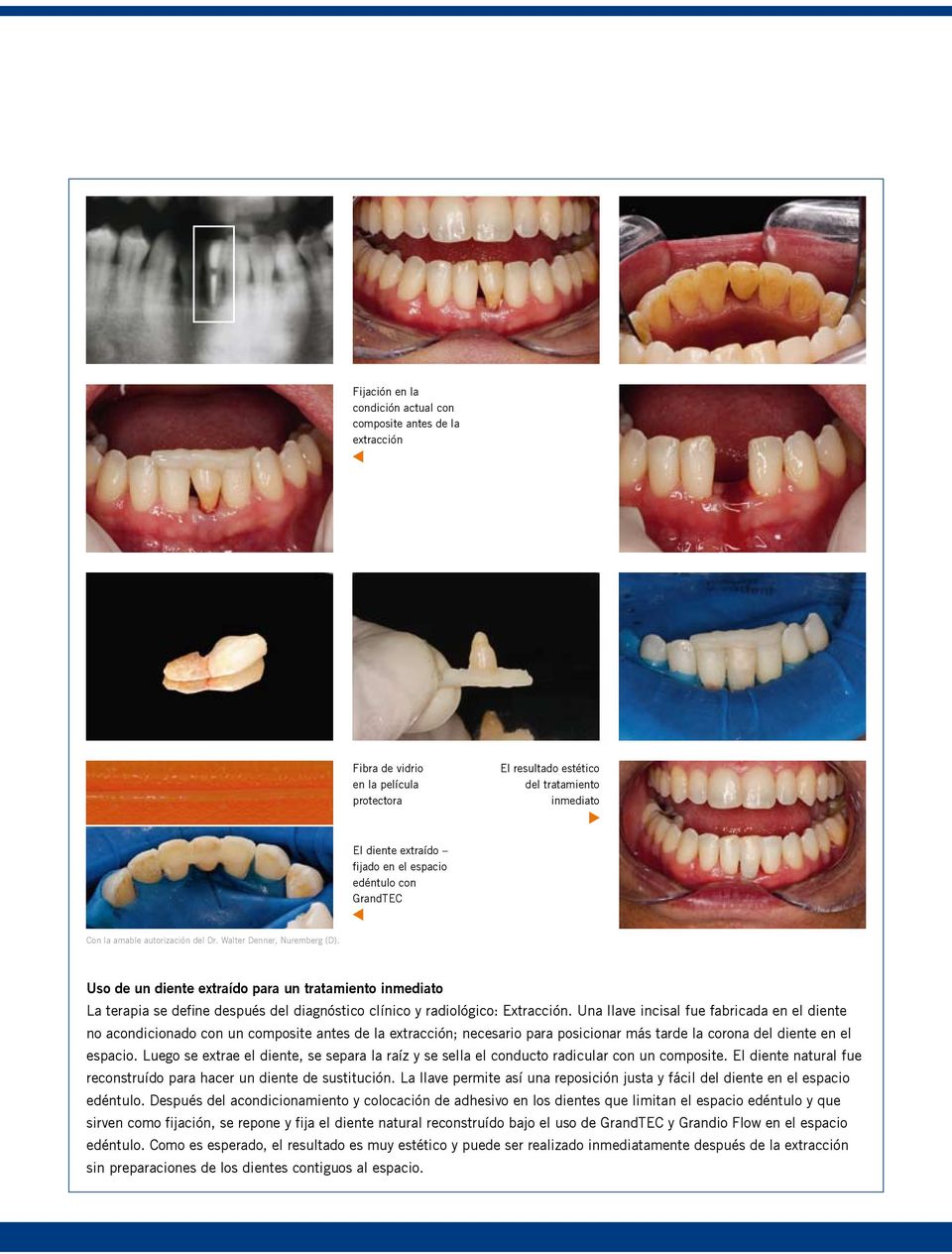 Uso de un diente extraído para un tratamiento inmediato La terapia se define después del diagnóstico clínico y radiológico: Extracción.