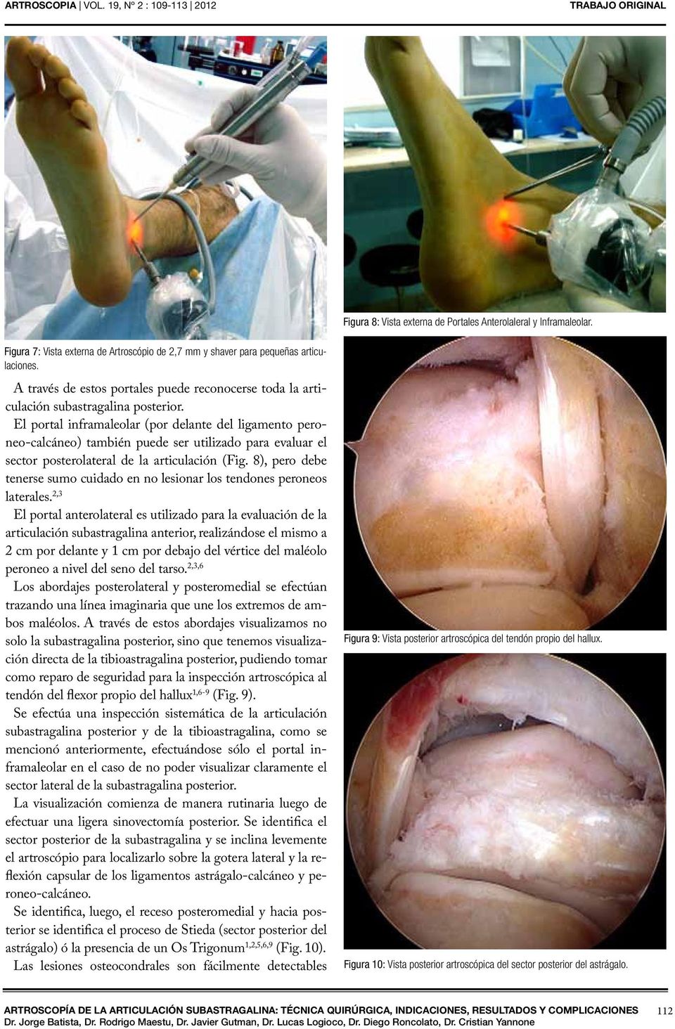El portal inframaleolar (por delante del ligamento peroneo-calcáneo) también puede ser utilizado para evaluar el sector posterolateral de la articulación (Fig.