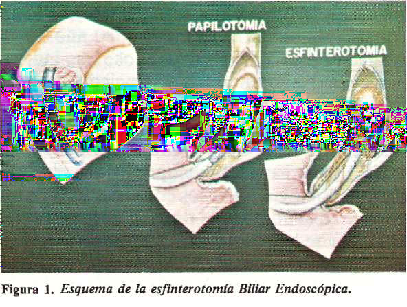 219 ESFINTEROTOMIA BILIAR ENDOSCOPICA J.