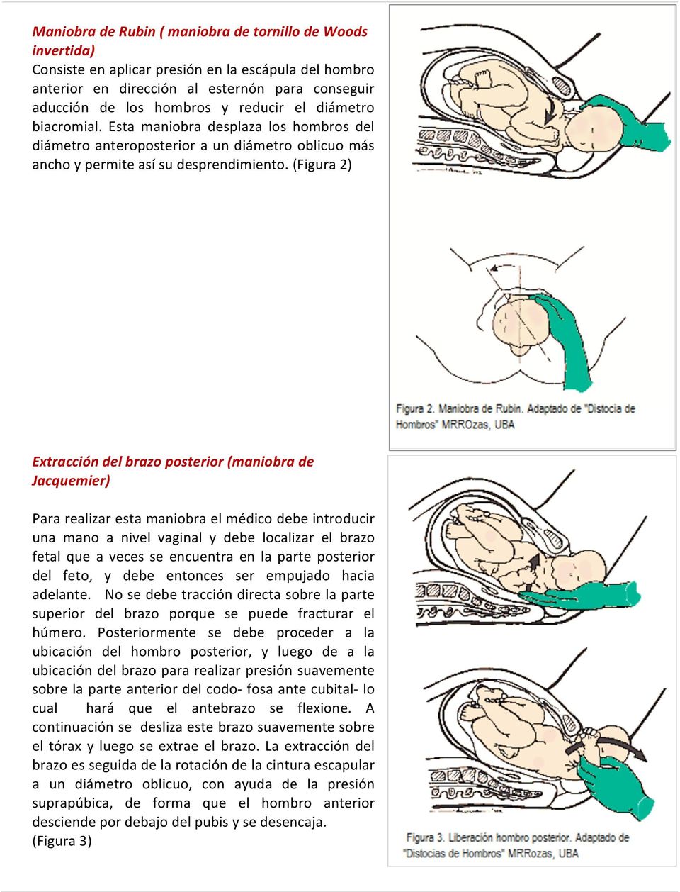 (Figura 2) Extracción del brazo posterior (maniobra de Jacquemier) Para realizar esta maniobra el médico debe introducir una mano a nivel vaginal y debe localizar el brazo fetal que a veces se