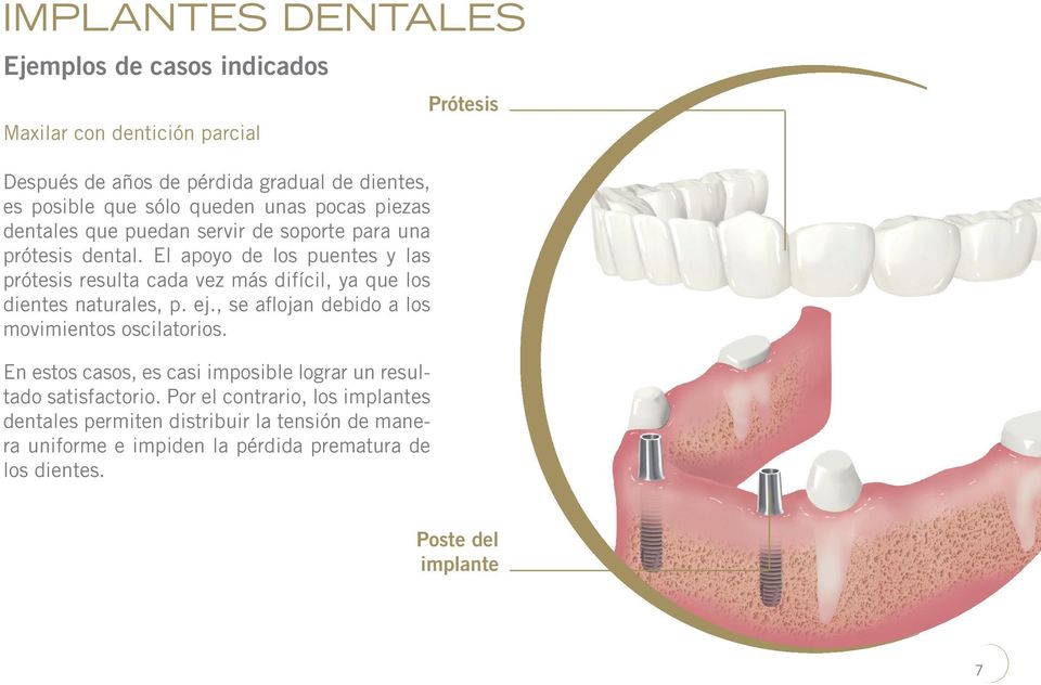 El apoyo de los puentes y las prótesis resulta cada vez más difícil, ya que los dientes naturales, p. ej.