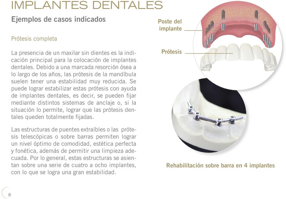 Se puede lograr estabilizar estas prótesis con ayuda de implantes dentales, es decir, se pueden fijar mediante distintos sistemas de anclaje o, si la situación lo permite, lograr que las prótesis