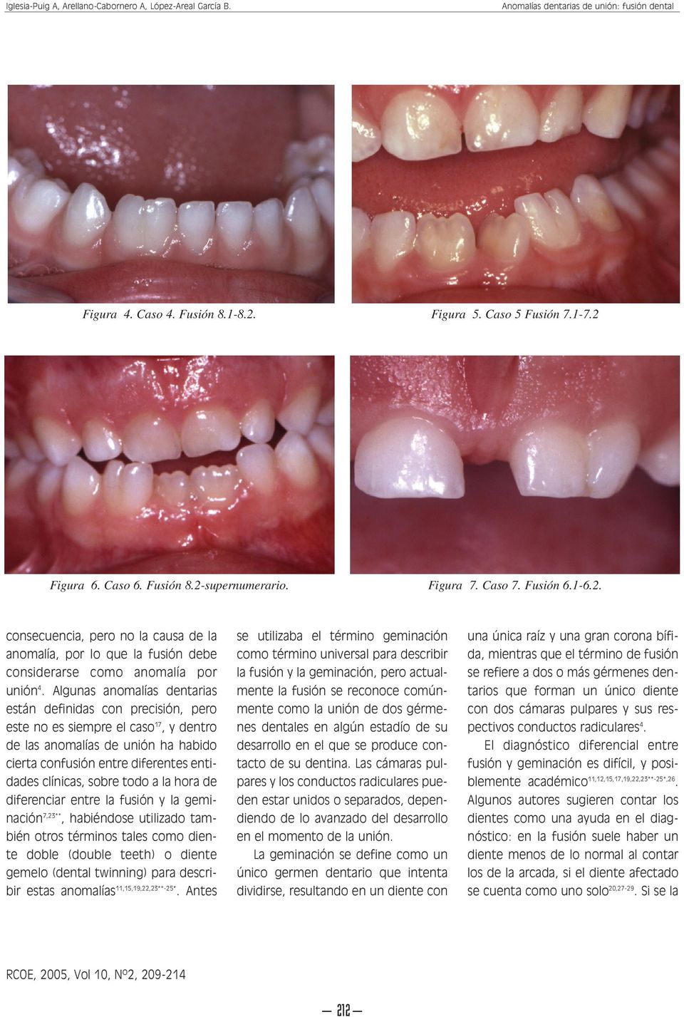 todo a la hora de diferenciar entre la fusión y la geminación 7,23**, habiéndose utilizado también otros términos tales como diente doble (double teeth) o diente gemelo (dental twinning) para