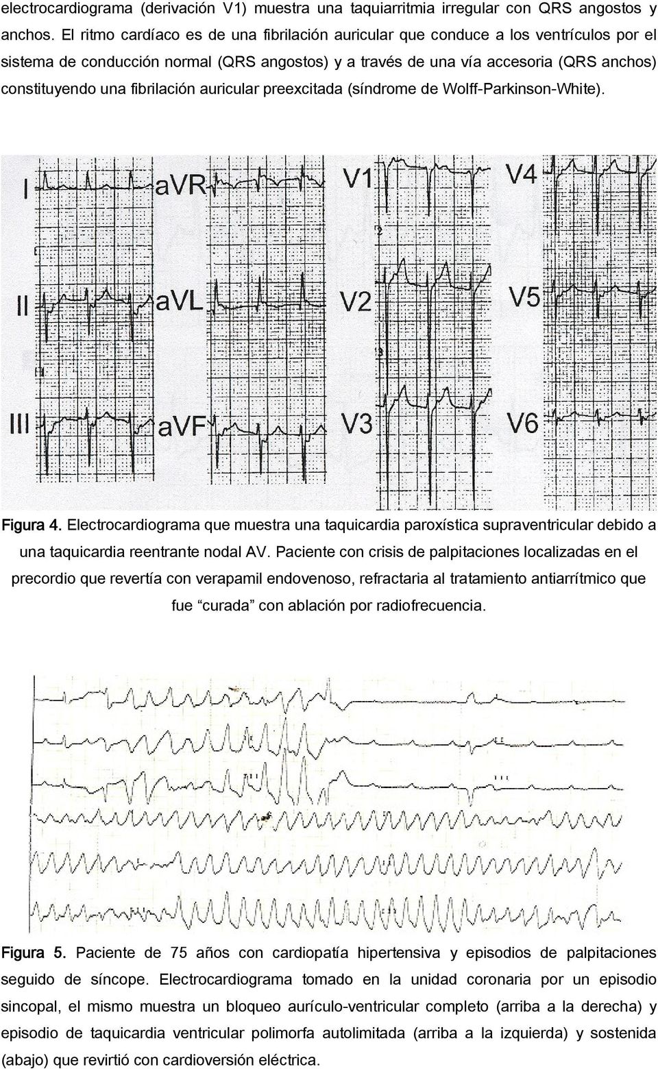 fibrilación auricular preexcitada (síndrome de Wolff-Parkinson-White). Figura 4.