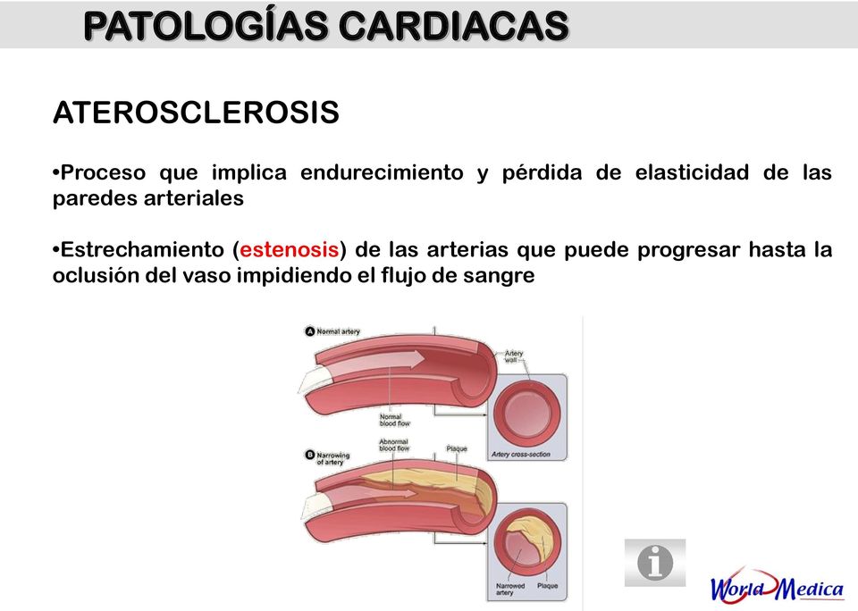 arteriales Estrechamiento (estenosis) de las arterias que