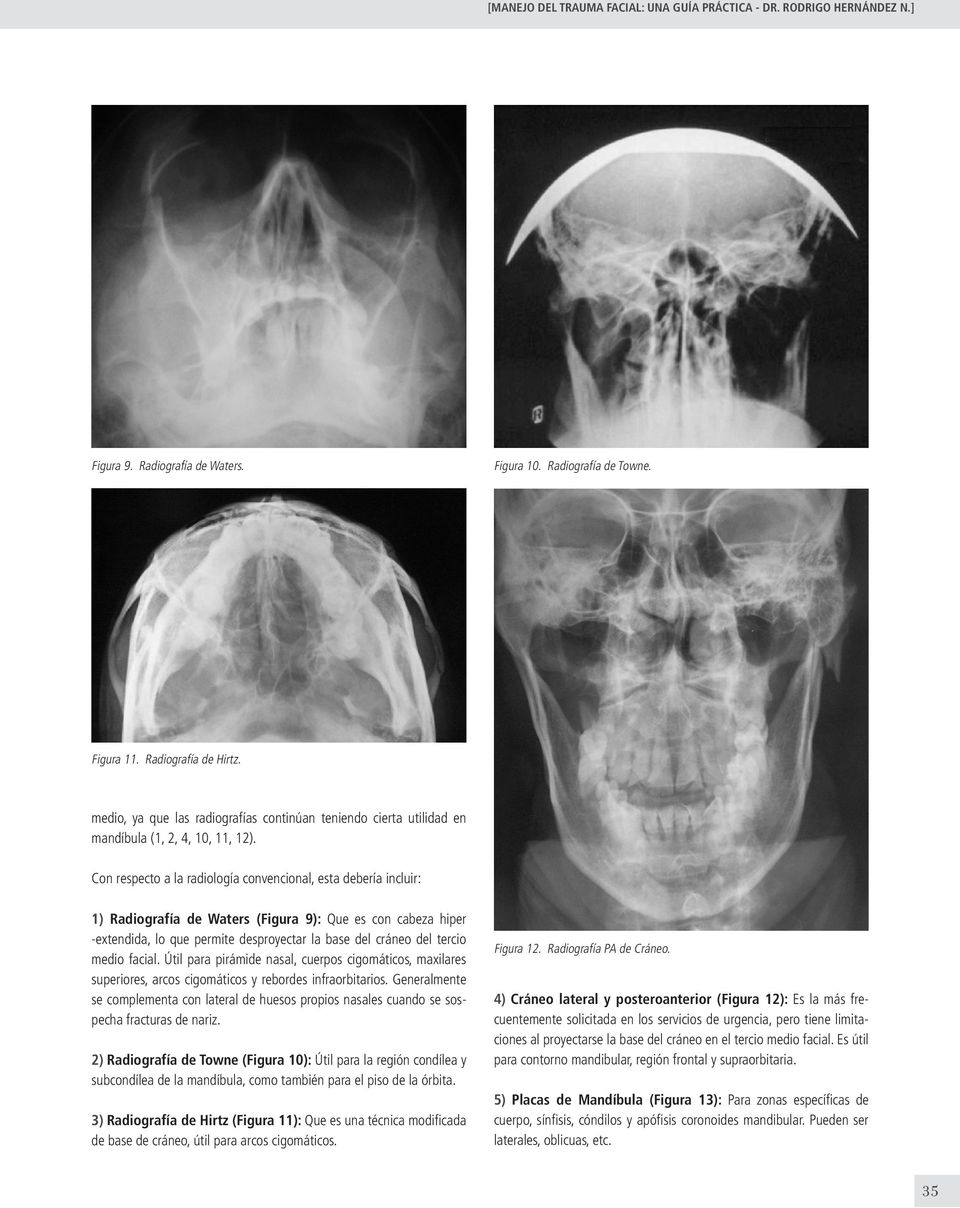Con respecto a la radiología convencional, esta debería incluir: 1) Radiografía de Waters (Figura 9): Que es con cabeza hiper -extendida, lo que permite desproyectar la base del cráneo del tercio