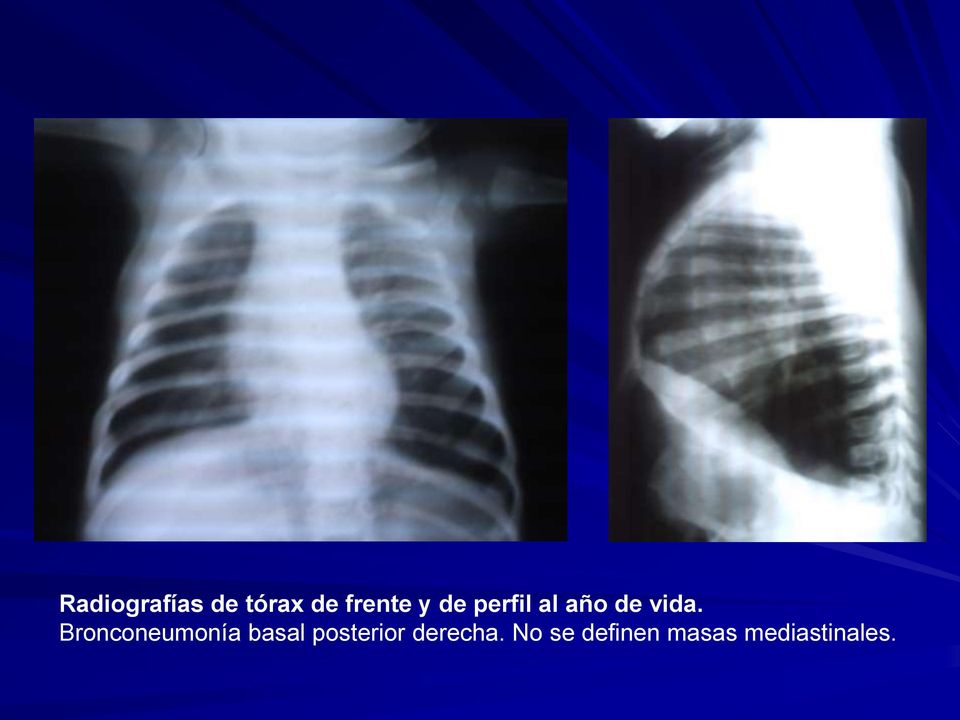 Bronconeumonía basal posterior