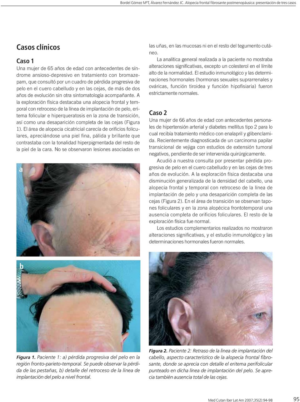 A la exploración física destacaba una alopecia frontal y temporal con retroceso de la línea de implantación de pelo, eritema folicular e hiperqueratosis en la zona de transición, así como una
