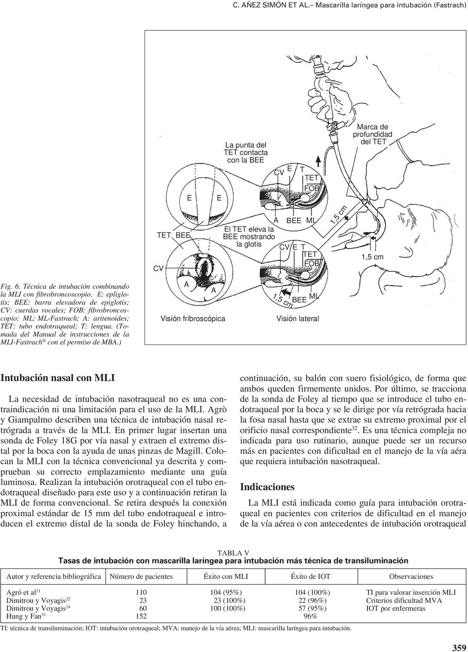 profundidad del TET 1,5 cm Fig. 6. Técnica de intubación combinando la MLI con fibrobroncoscopio.