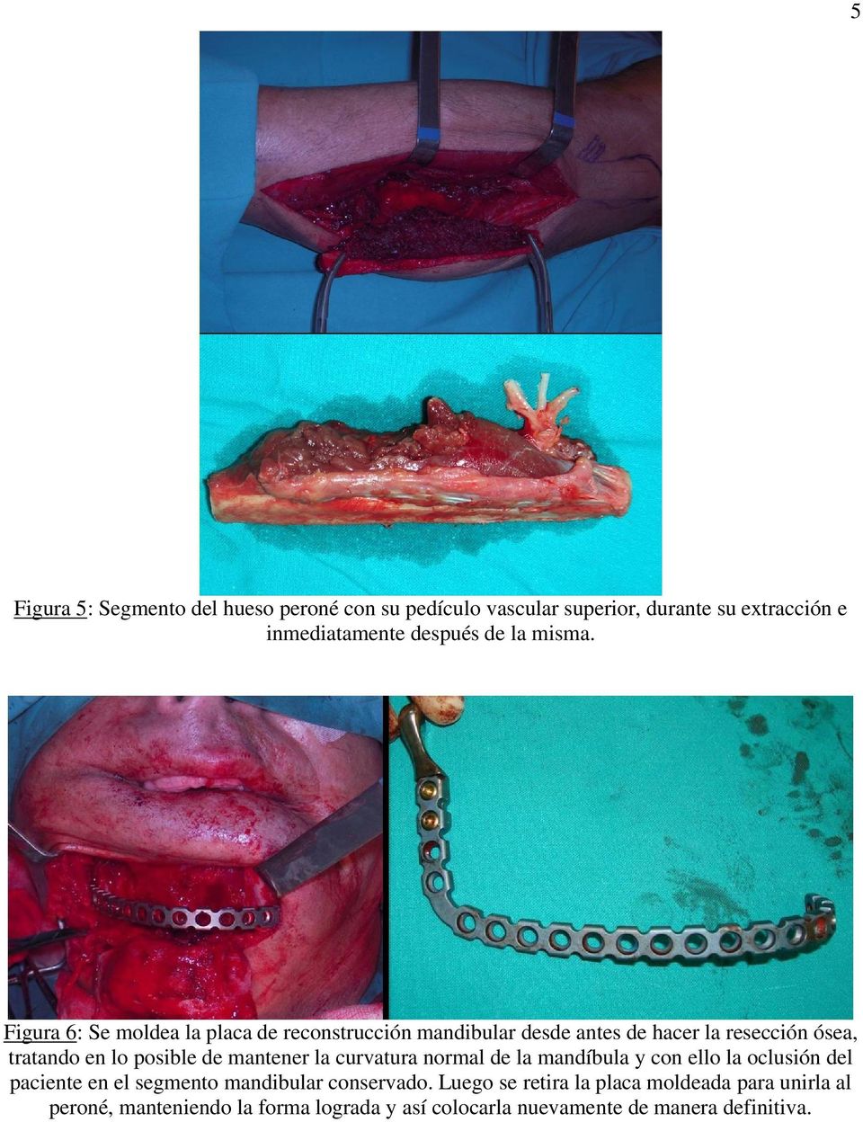Figura 6: Se moldea la placa de reconstrucción mandibular desde antes de hacer la resección ósea, tratando en lo posible de