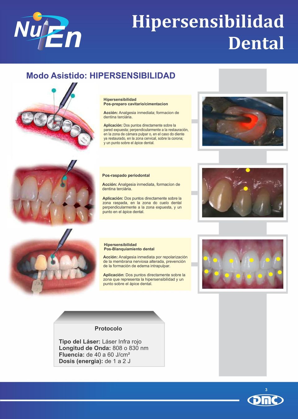corona; y un punto sobre el ápice dental. Pos-raspado periodontal Acción: Analgesia inmediata, formacíon de dentina terciária.
