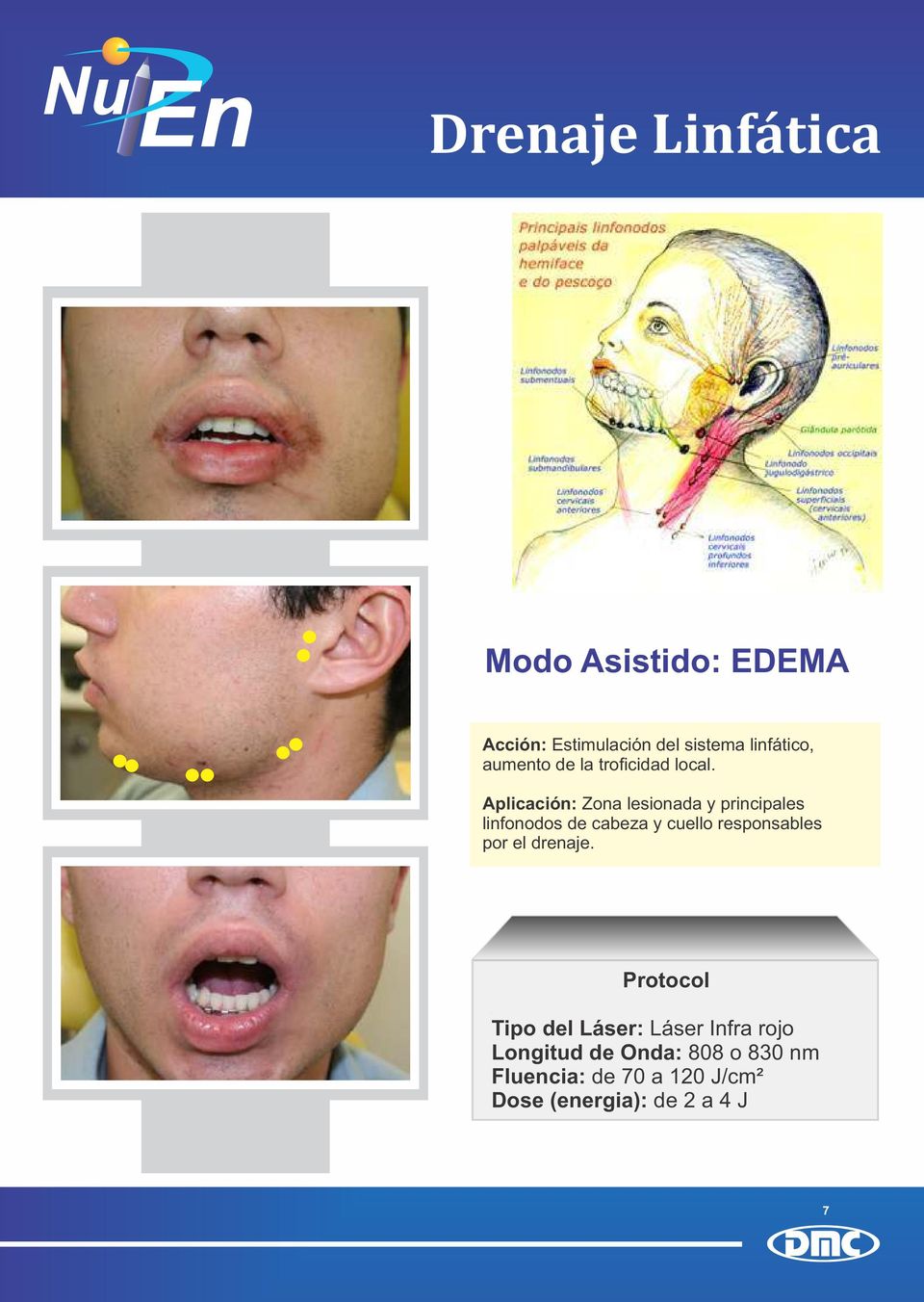 Aplicación: Zona lesionada y principales linfonodos de cabeza y