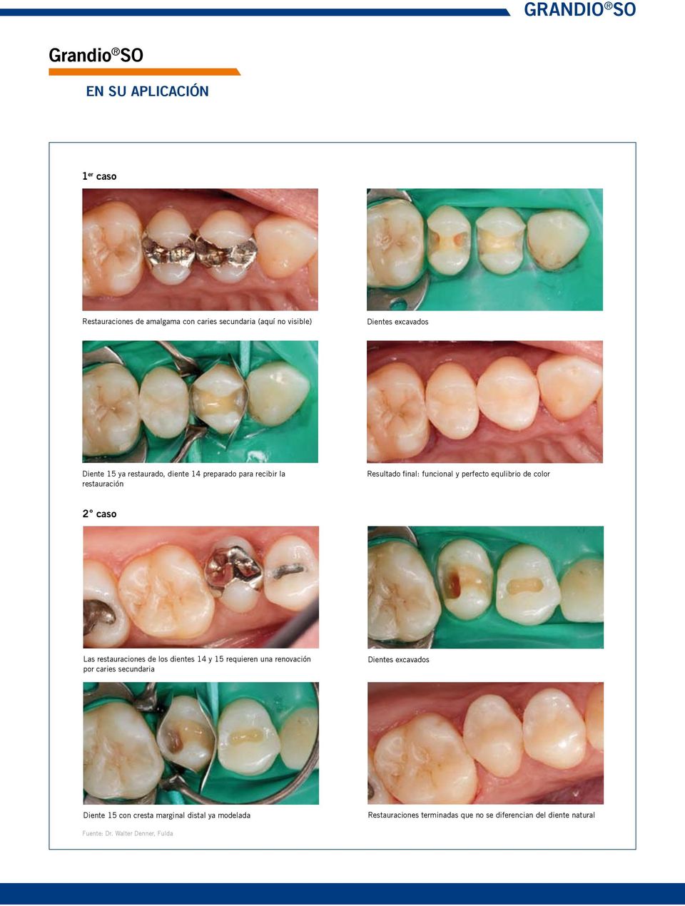 color 2 caso Las restauraciones de los dientes 14 y 15 requieren una renovación por caries secundaria Dientes excavados Diente