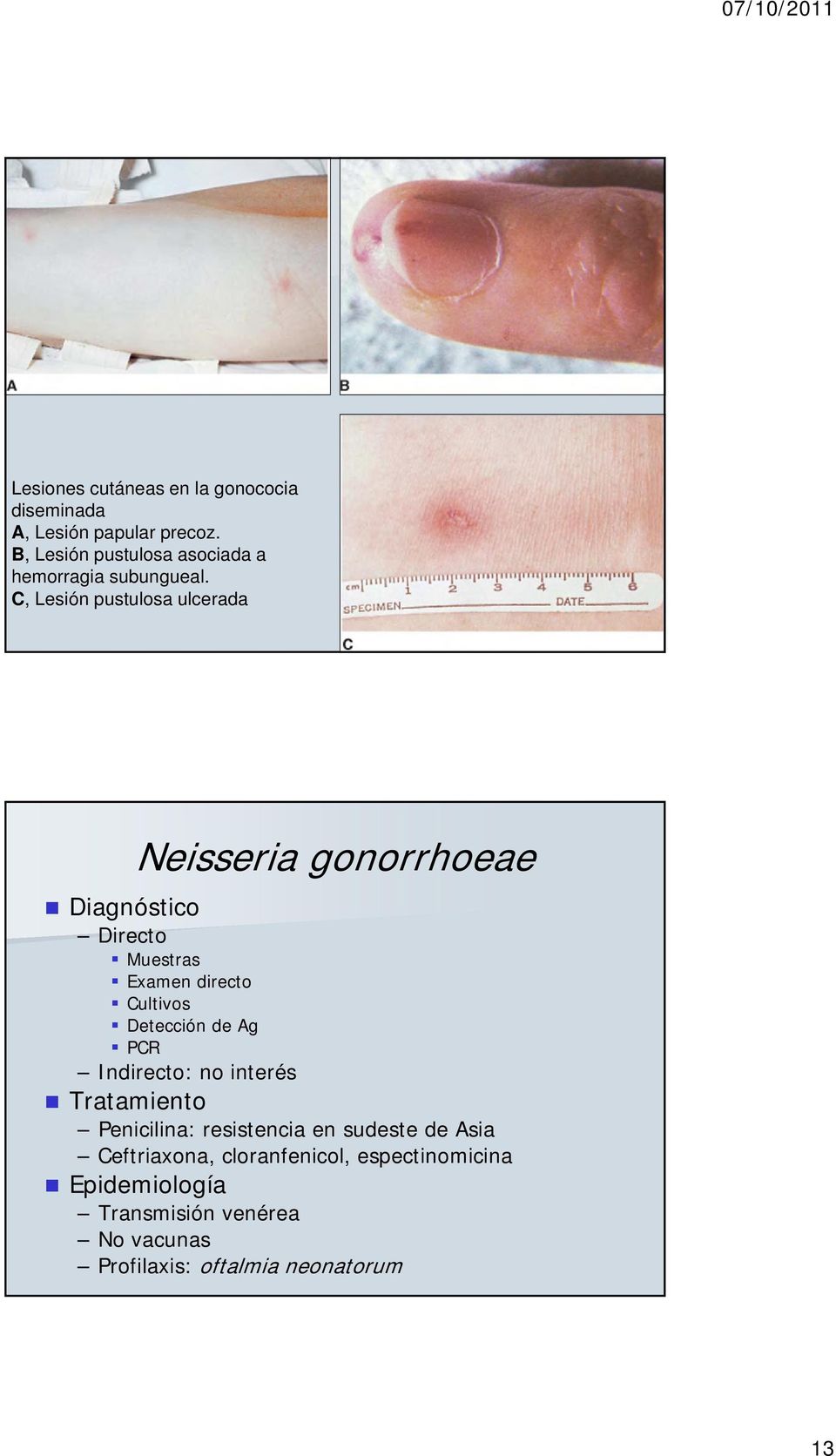 C, Lesión pustulosa ulcerada Neisseria gonorrhoeae Diagnóstico Directo Muestras Examen directo Cultivos