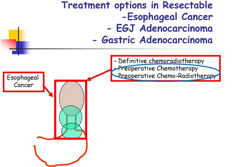 Esophageal Cancer - Definitive chemoradiotherapy -