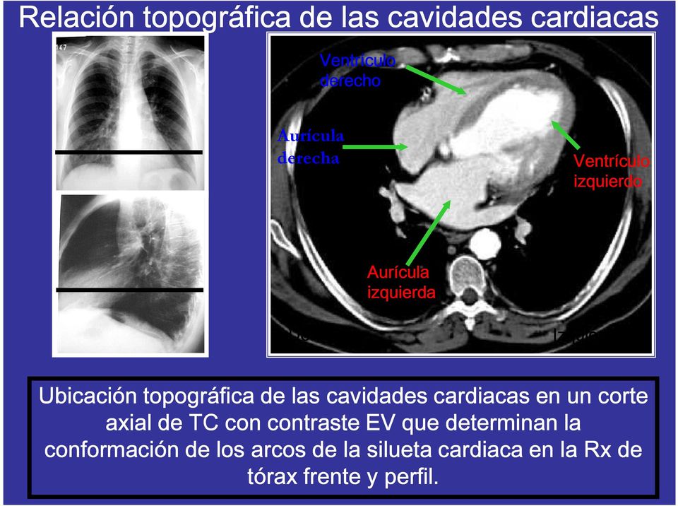 las cavidades cardiacas en un corte axial de TC con contraste EV que determinan la