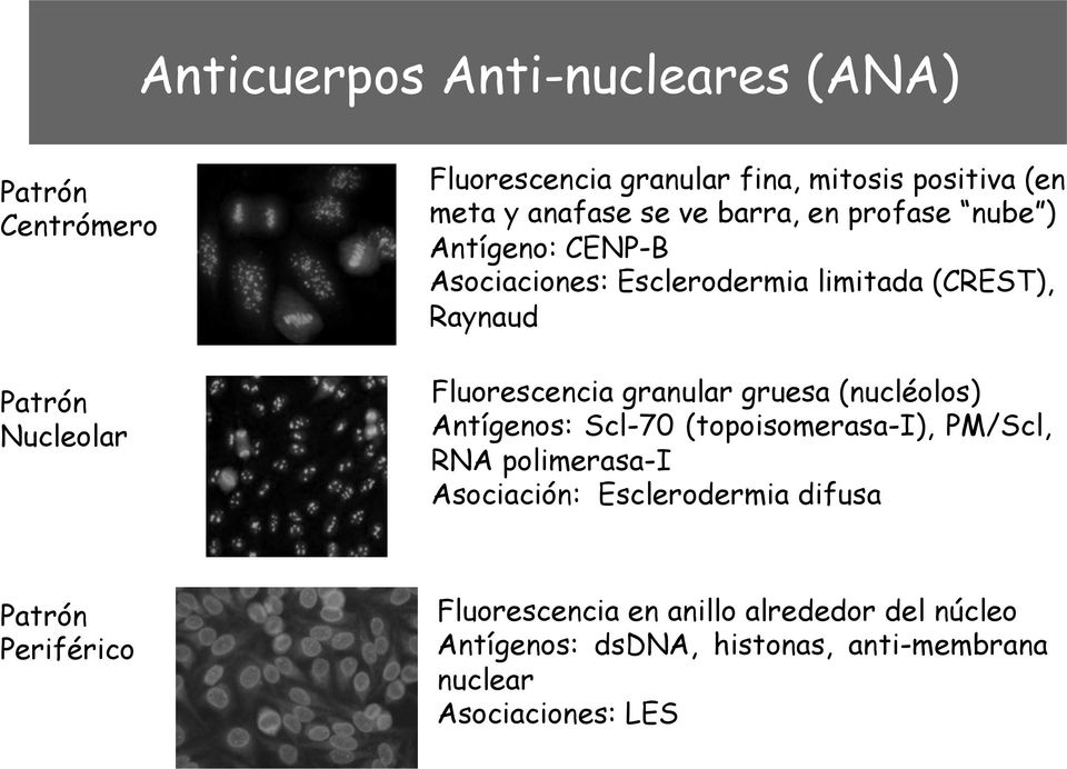 granular gruesa (nucléolos) Antígenos: Scl-70 (topoisomerasa-i), PM/Scl, RNA polimerasa-i Asociación: Esclerodermia difusa