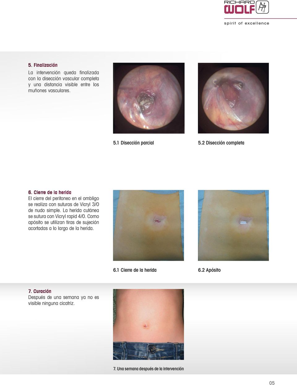 Cierre de la herida El cierre del peritoneo en el ombligo se realiza con suturas de Vicryl 3/0 de nudo simple.
