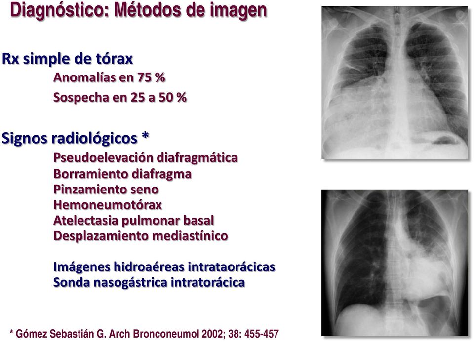 Hemoneumotórax Atelectasia pulmonar basal Desplazamiento mediastínico Imágenes hidroaéreas