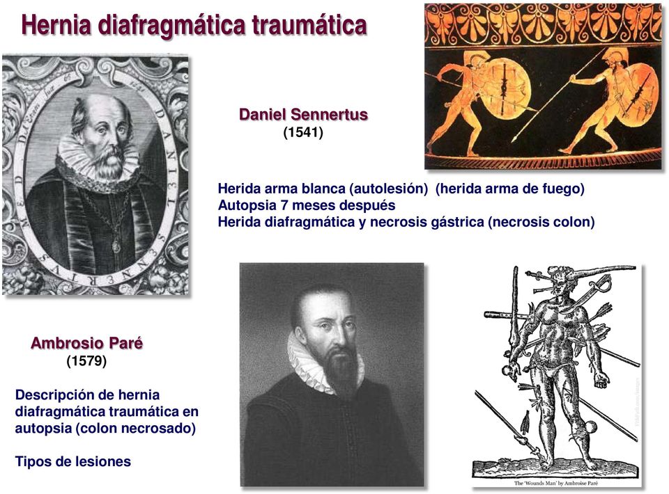 diafragmática y necrosis gástrica (necrosis colon) Ambrosio Paré (1579)