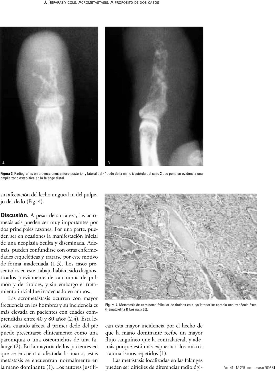 sin afectación del lecho ungueal ni del pulpejo del dedo (Fig. 4). Figura 4. Metástasis de carcinoma folicular de tiroides en cuyo interior se aprecia una trabécula ósea (Hematoxilina & Eosina, x 20).