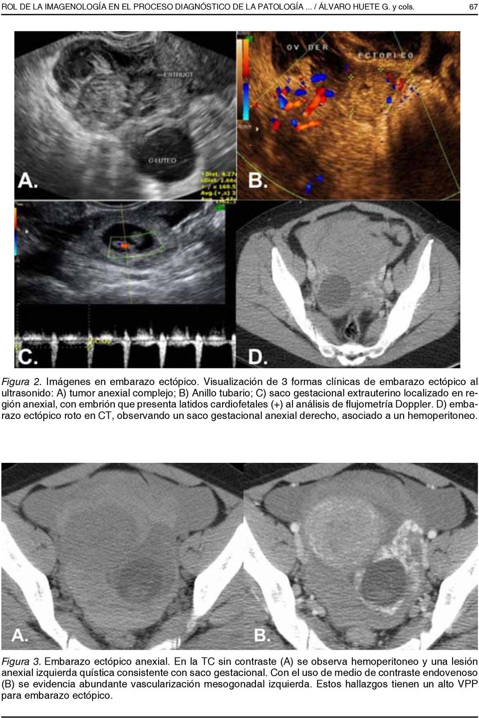 presenta latidos cardiofetales (+) al análisis de flujometría Doppler. D) embarazo ectópico roto en CT, observando un saco gestacional anexial derecho, asociado a un hemoperitoneo. Figura 3.