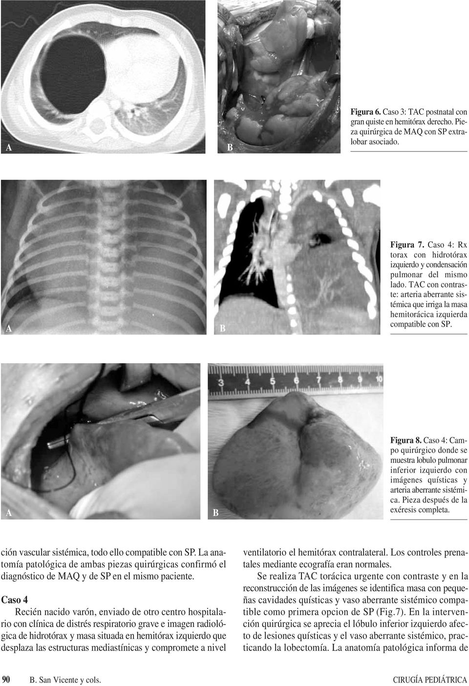Caso 4: Campo quirúrgico donde se muestra lobulo pulmonar inferior izquierdo con imágenes quísticas y arteria aberrante sistémica. Pieza después de la exéresis completa.