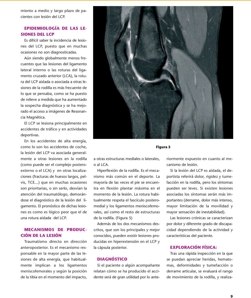 Aún siendo globalmente menos frecuentes que las lesiones del ligamento lateral interno o las roturas del ligamento cruzado anterior (LCA), la rotura del LCP aislada o asociada a otras lesiones de la