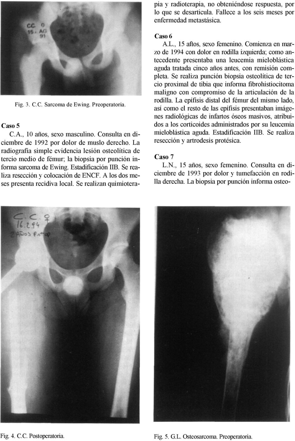 La radiografía simple evidencia lesión osteolítica de tercio medio de fémur; la biopsia por punción informa sarcoma de Ewing. Estadificación IIB. Se realiza resección y colocación de ENCF.