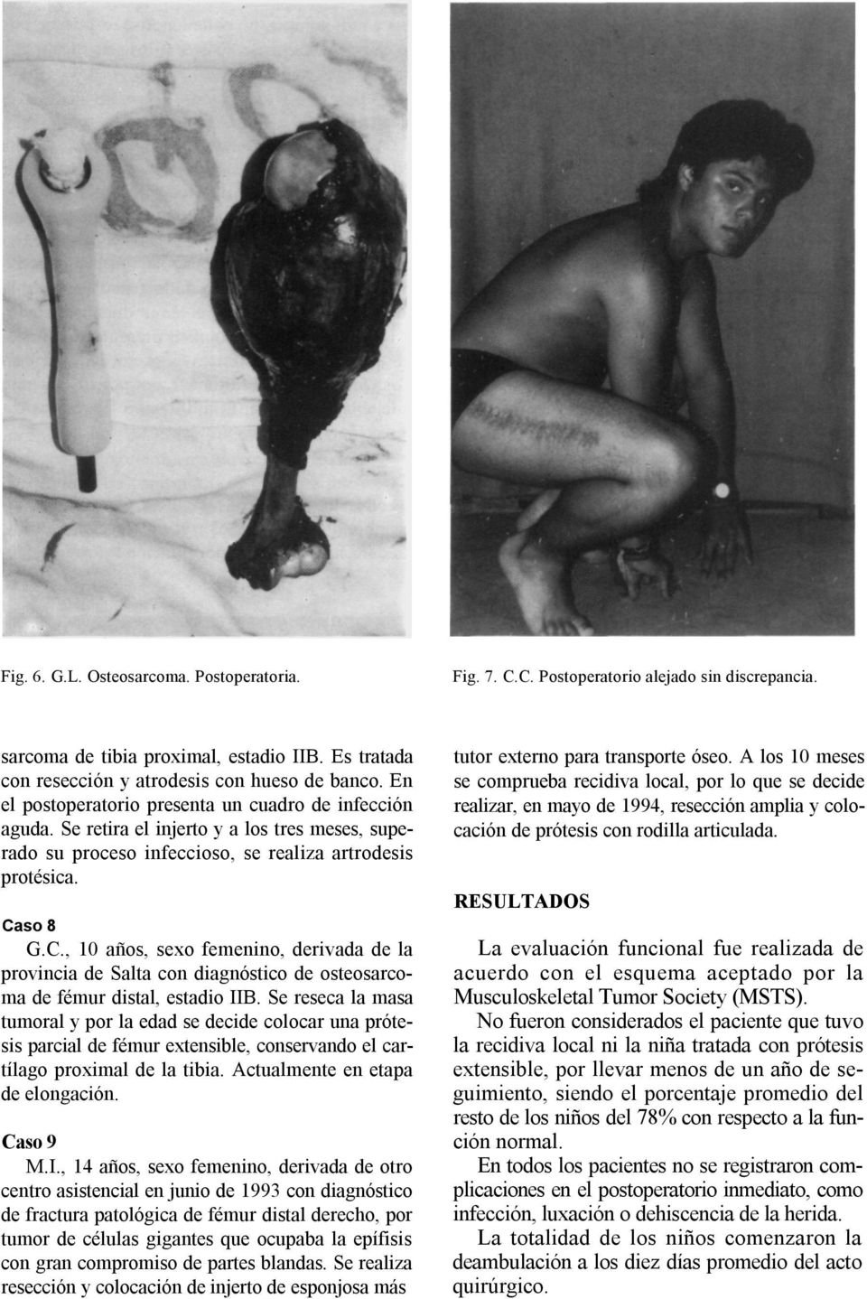 so 8 G.C., 10 años, sexo femenino, derivada de la provincia de Salta con diagnóstico de osteosarcoma de fémur distal, estadio IIB.