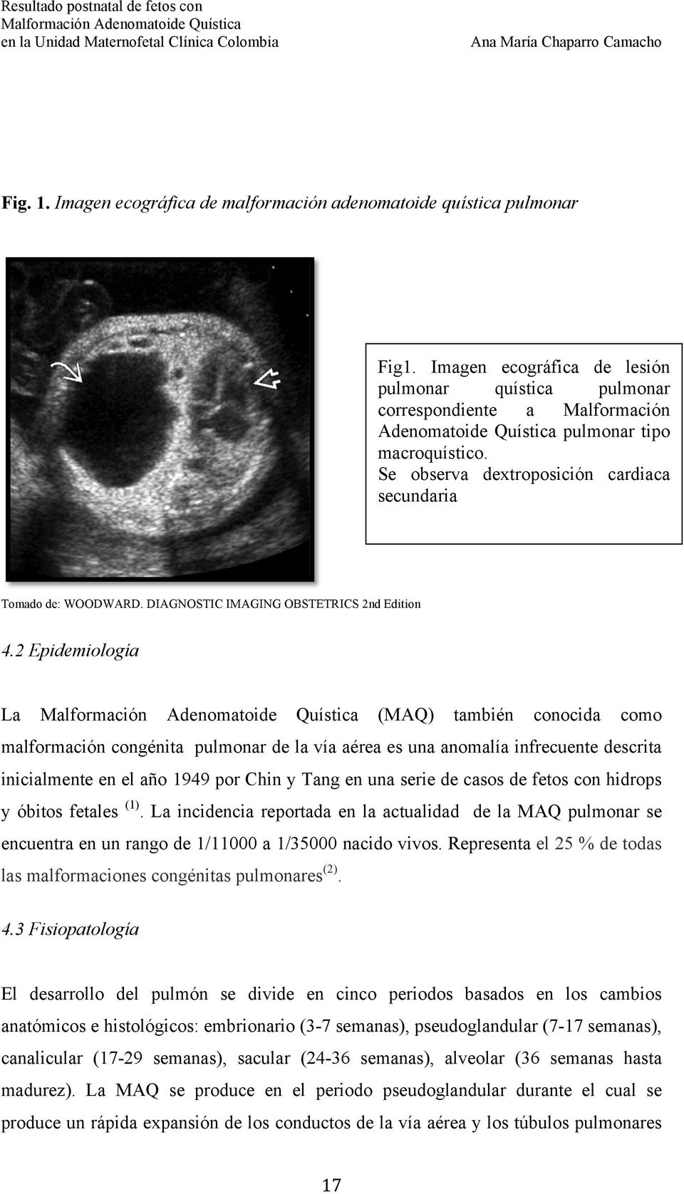 Se observa dextroposición cardiaca secundaria Tomado de: WOODWARD. DIAGNOSTIC IMAGING OBSTETRICS 2nd Edition 4.