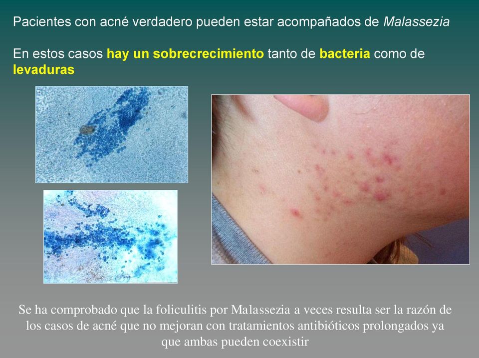 la foliculitis por Malassezia a veces resulta ser la razón de los casos de acné