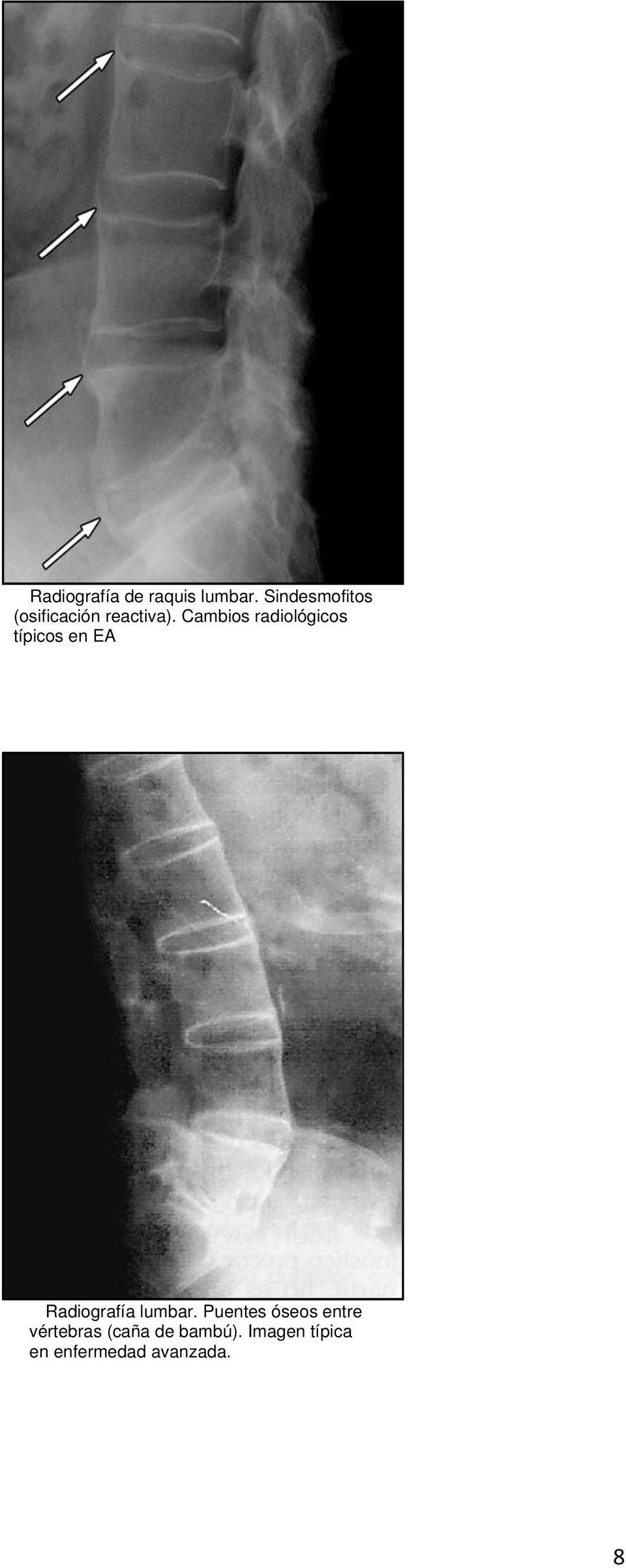 Cambios radiológicos típicos en EA Radiografía