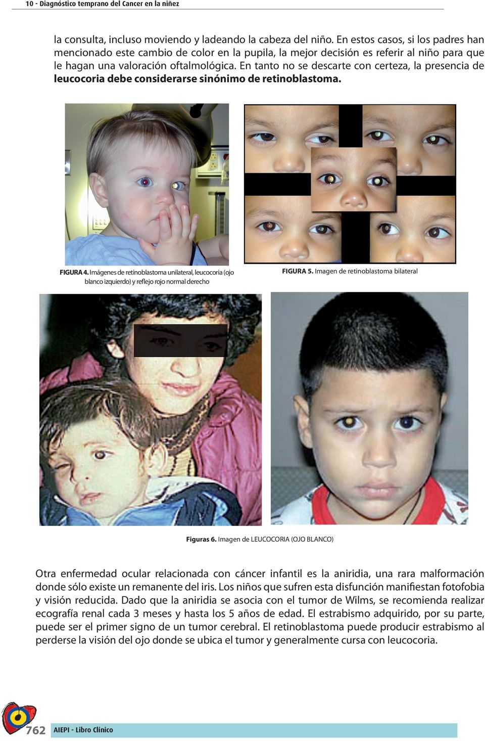En tanto no se descarte con certeza, la presencia de leucocoria debe considerarse sinónimo de retinoblastoma. FIGURA 4.
