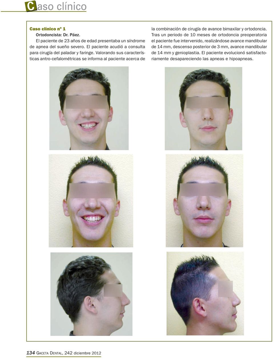 Valorando sus características antro-cefalométricas se informa al paciente acerca de la combinación de cirugía de avance bimaxilar y ortodoncia.