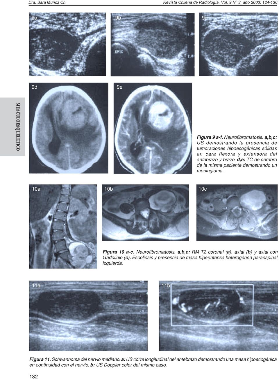 d,e: TC de cerebro de la misma paciente demostrando un meningioma. 10a 10b 10c Figura 10 a-c. Neurofibromatosis.