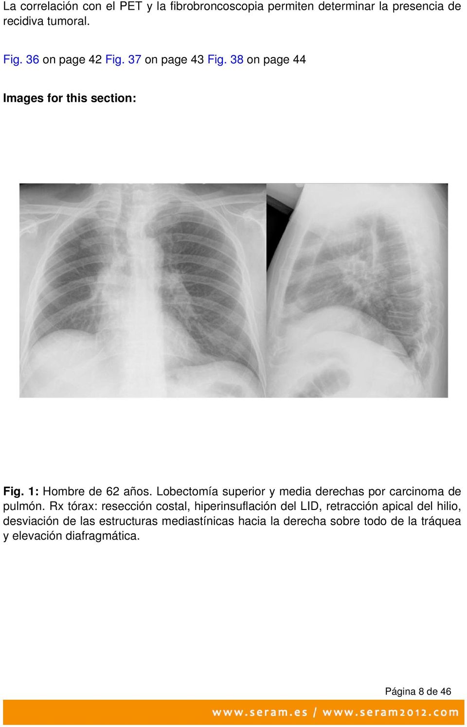 Lobectomía superior y media derechas por carcinoma de pulmón.