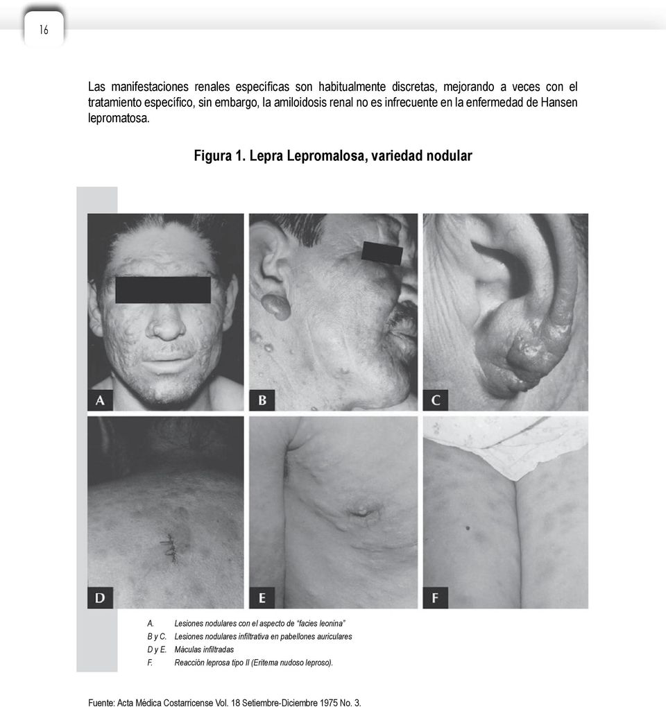 Lesiones nodulares con el aspecto de facies leonina B y C. Lesiones nodulares infiltrativa en pabellones auriculares D y E.
