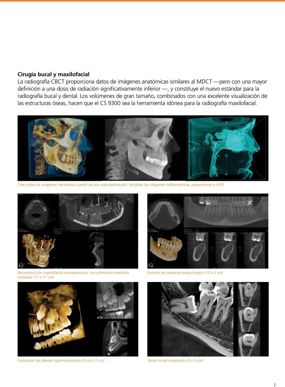 Los volúmenes de gran tamaño, combinados con una excelente visualización de las estructuras óseas, hacen que el CS 9300 sea la herramienta idónea para la radiografía maxilofacial.