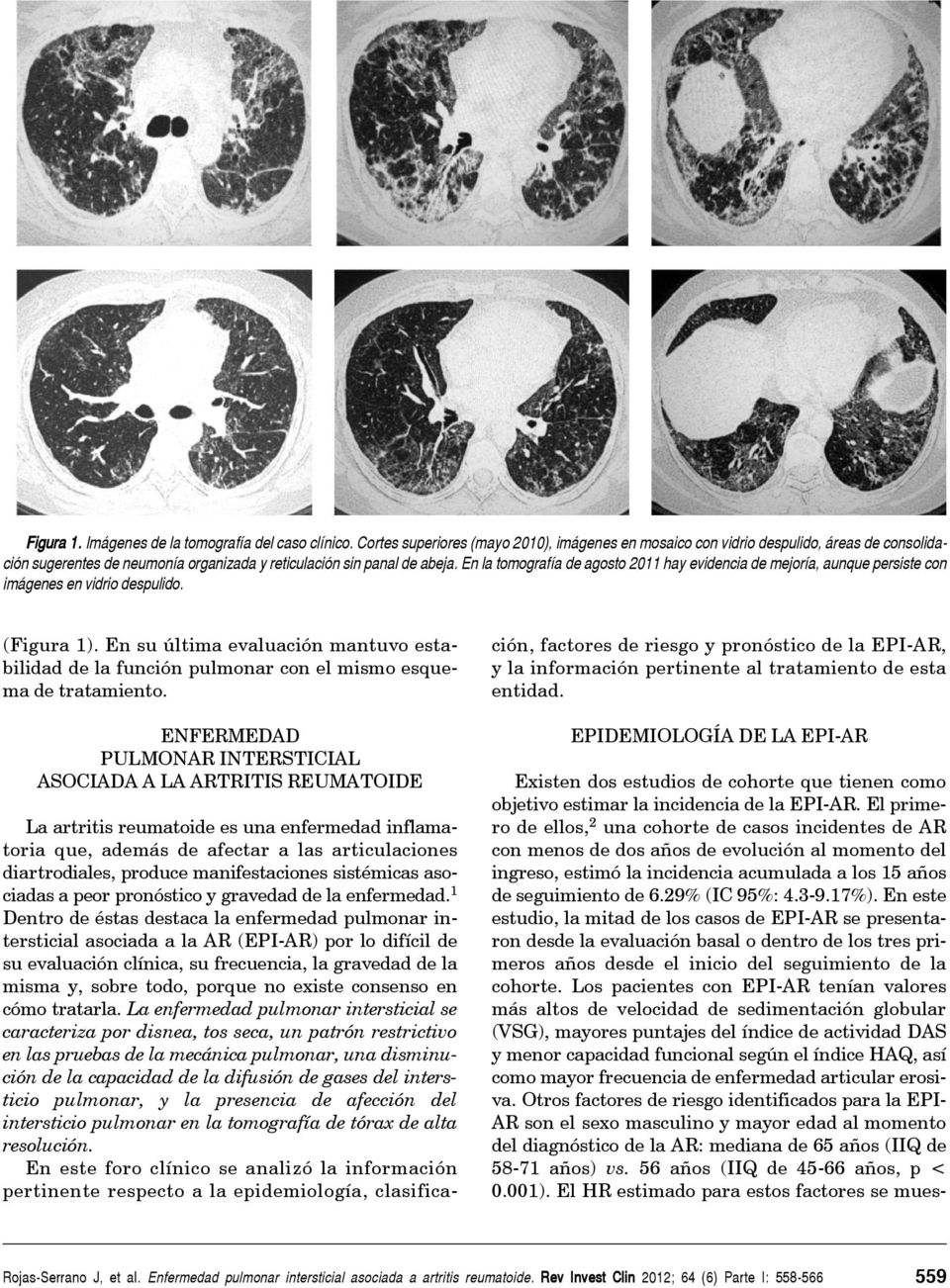 En la tomografía de agosto 2011 hay evidencia de mejoría, aunque persiste con imágenes en vidrio despulido. (Figura 1).