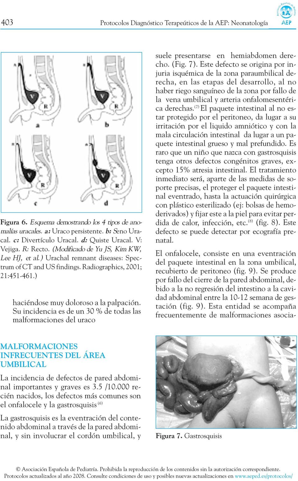 ) El onfalocele, consiste en una eventración del paquete intestinal en la zona umbilical, recubierto de peritoneo (fig. 9).