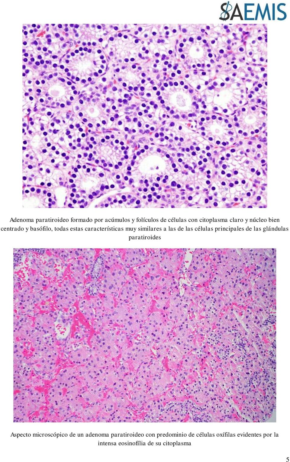 células principales de las glándulas paratiroides Aspecto microscópico de un adenoma