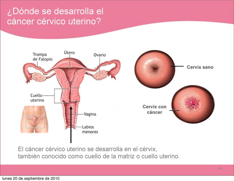 El cáncer cérvico uterino se desarrolla