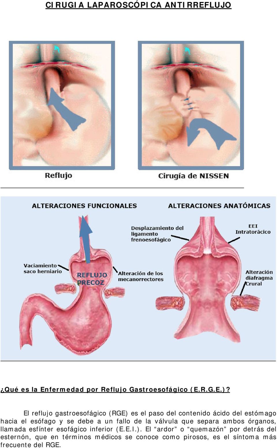 un fallo de la válvula que separa ambos órganos, llamada esfínter esofágico inferior (E.E.I.).