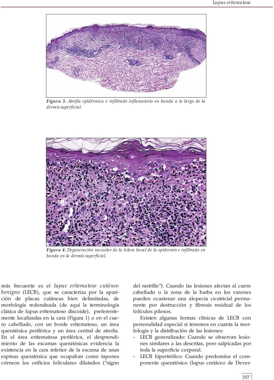 más frecuente es el lupus eritematoso cutáneo benigno (LECB), que se caracteriza por la aparición de placas cutáneas bien delimitadas, de morfología redondeada (de aquí la terminología clásica de