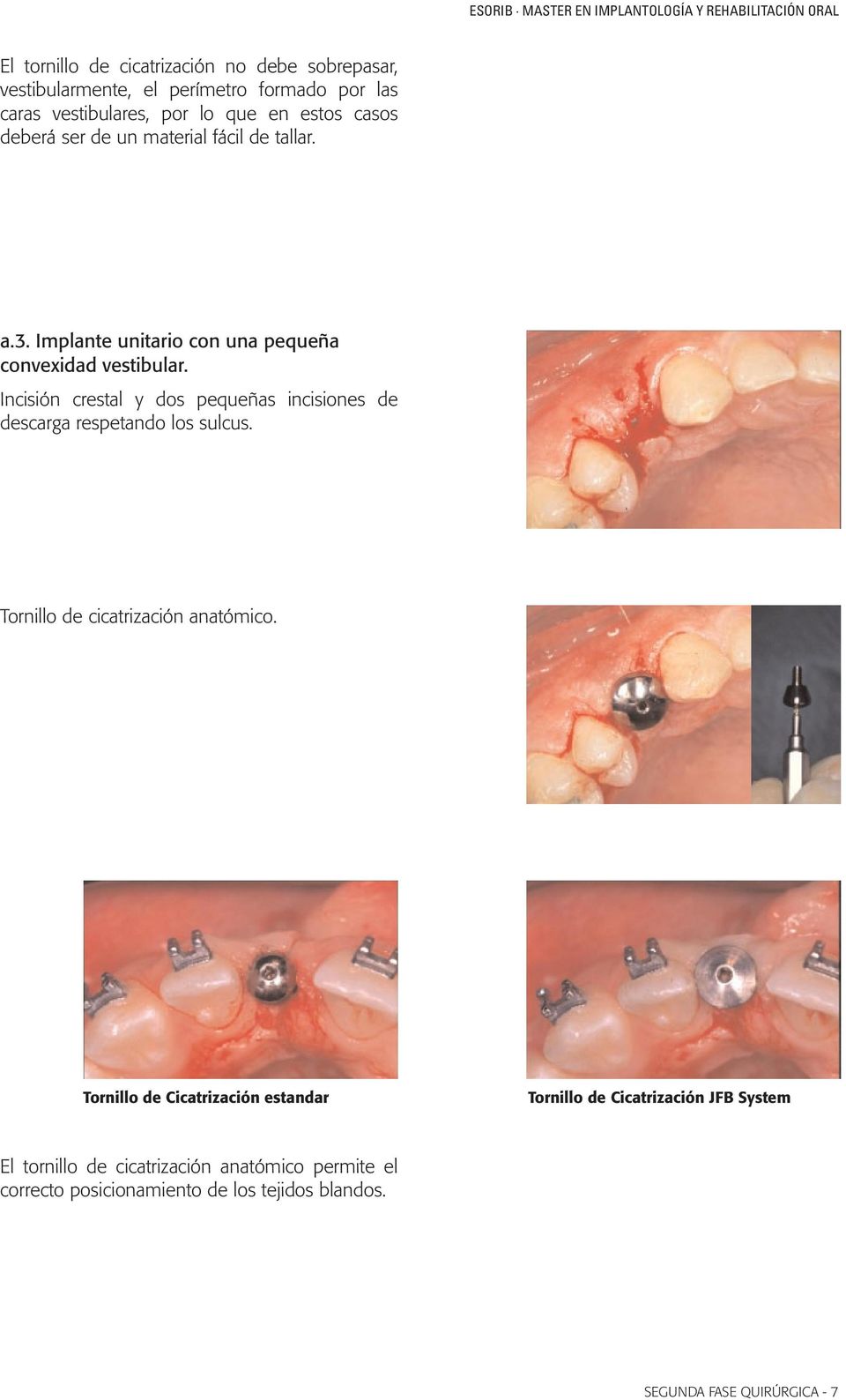 Incisión crestal y dos pequeñas incisiones de descarga respetando los sulcus. Tornillo de cicatrización anatómico.