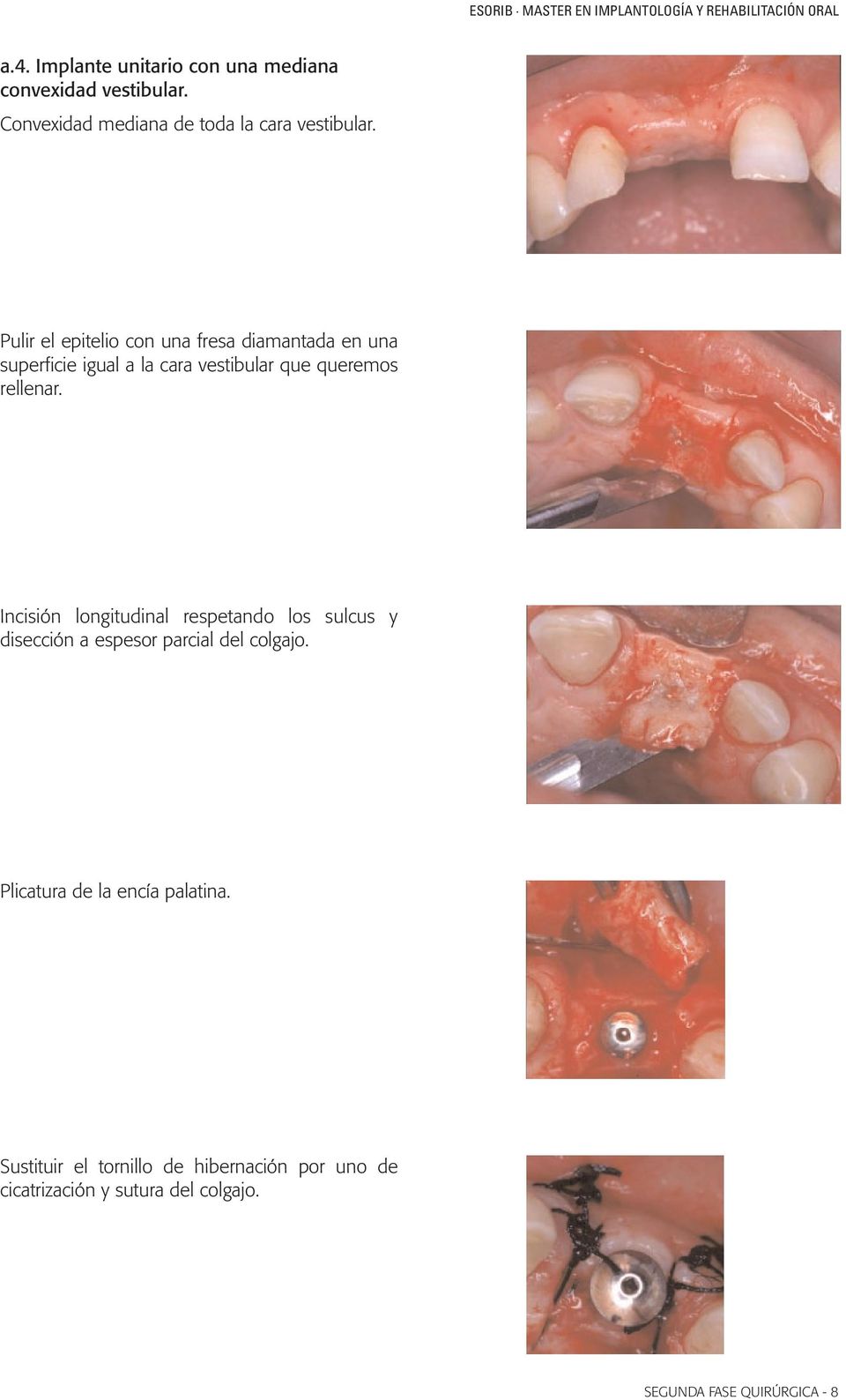 Incisión longitudinal respetando los sulcus y disección a espesor parcial del colgajo.