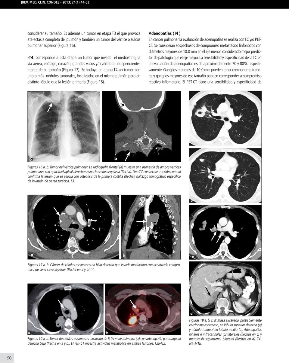 -T4: corresponde a esta etapa un tumor que invade el mediastino, la vía aérea, esófago, corazón, grandes vasos y/o vértebra, independientemente de su tamaño (Figura 17).