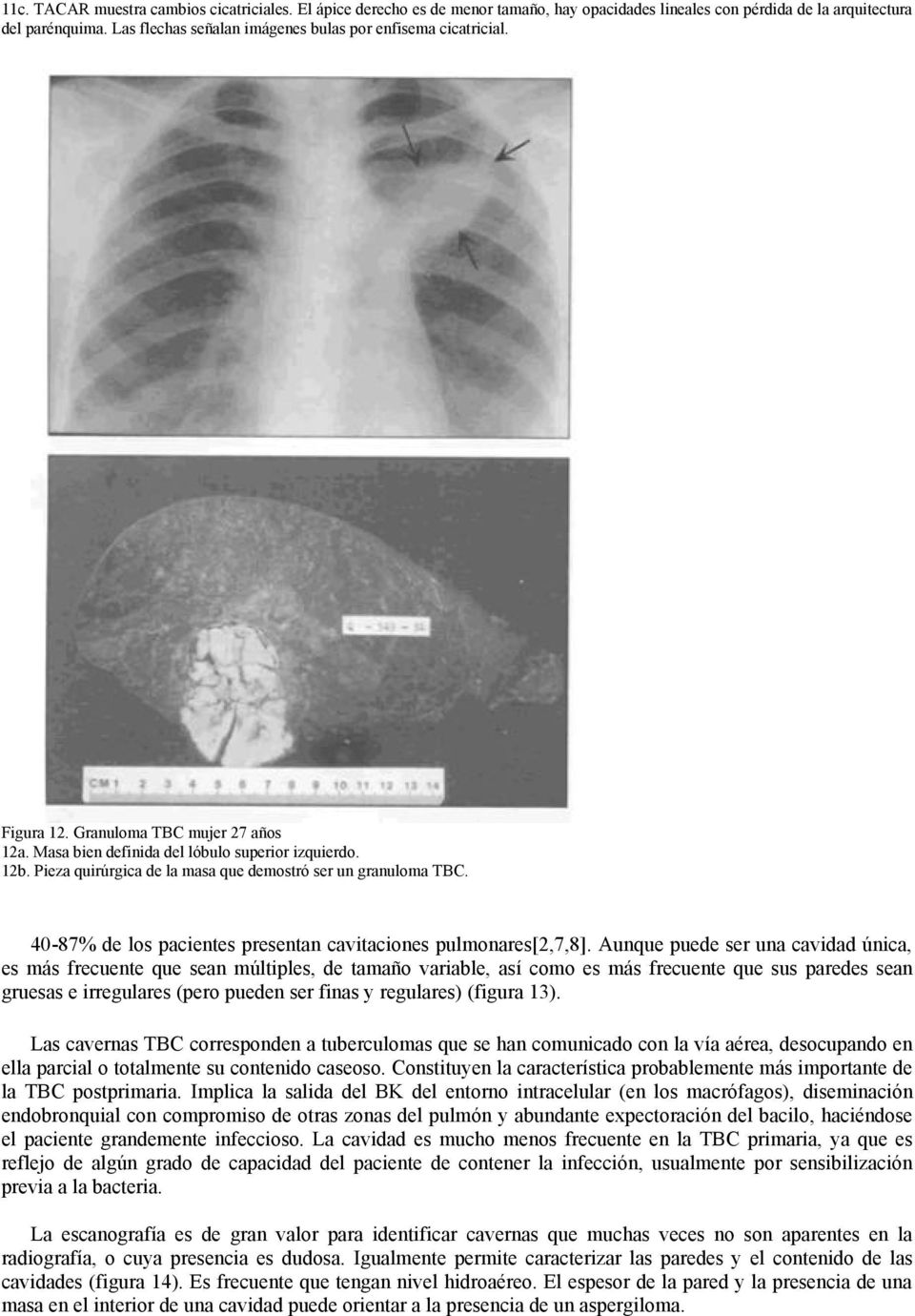 Pieza quirúrgica de la masa que demostró ser un granuloma TBC. 40-87% de los pacientes presentan cavitaciones pulmonares[2,7,8].