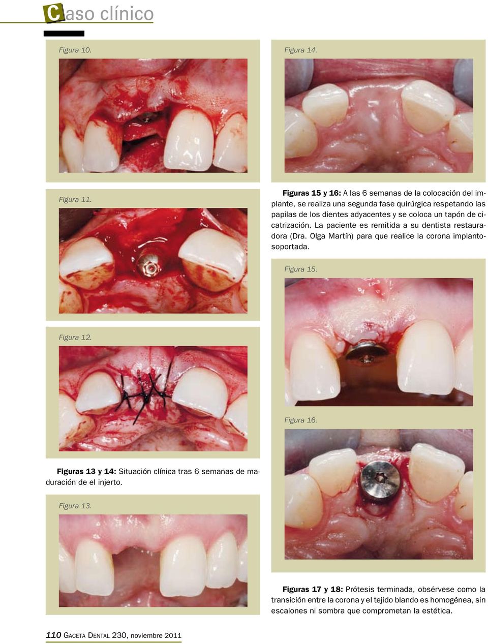 tapón de cicatrización. La paciente es remitida a su dentista restauradora (Dra. Olga Martín) para que realice la corona implantosoportada. Figura 15. Figura 12.